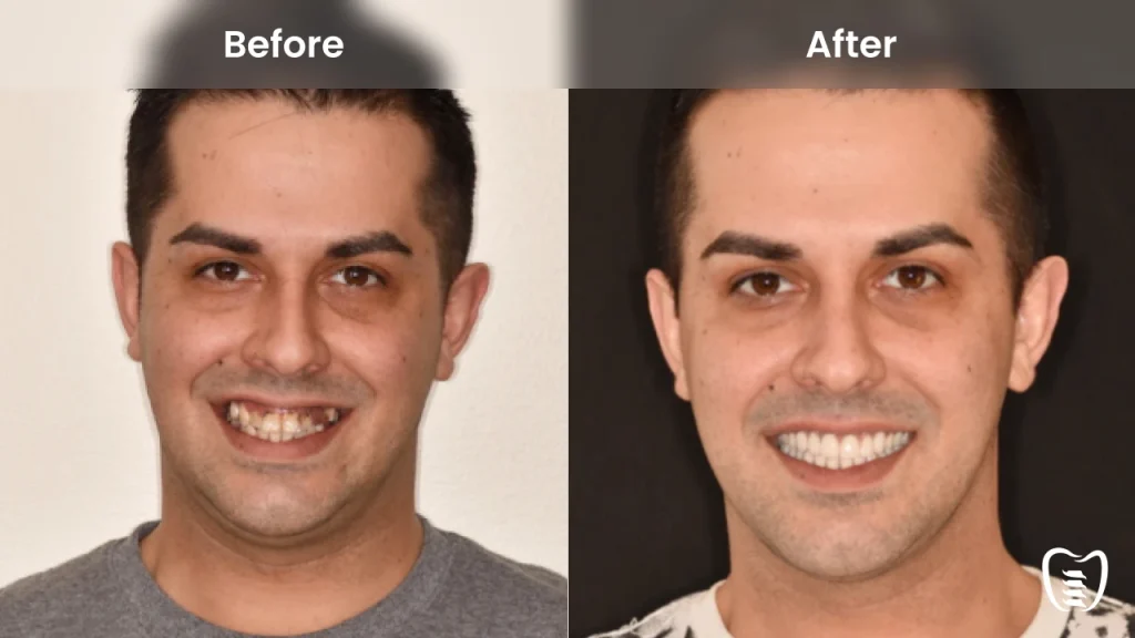 Before and after dental implants at All On Implants Columbia