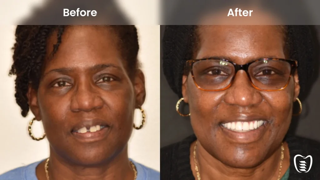 Before and after dental implants at All On Implants Columbia