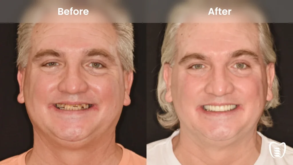 Before and after dental implants at All On Implants Columbia