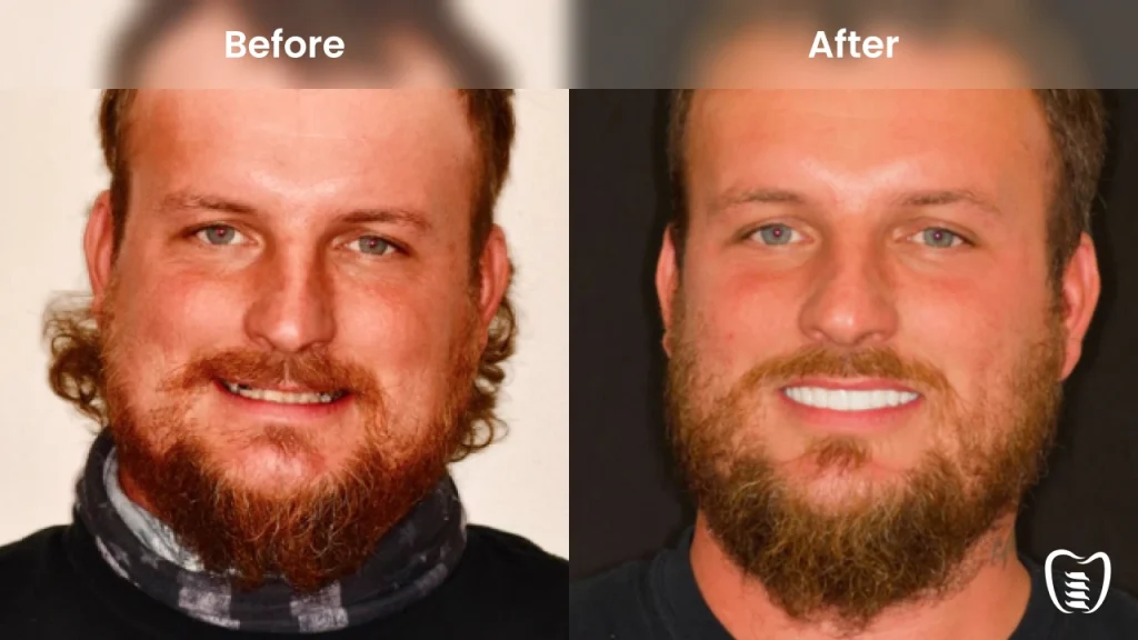 Before and after dental implants at All On Implants Columbia