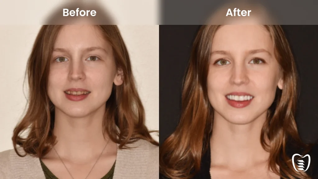 Before and after dental implants at All On Implants Columbia