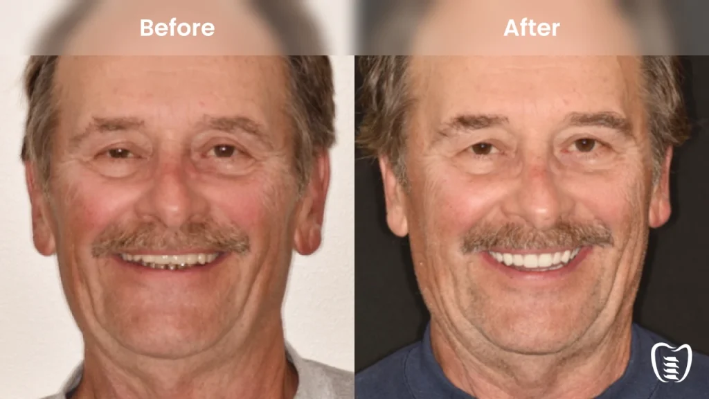 Before and after dental implants at All On Implants Columbia