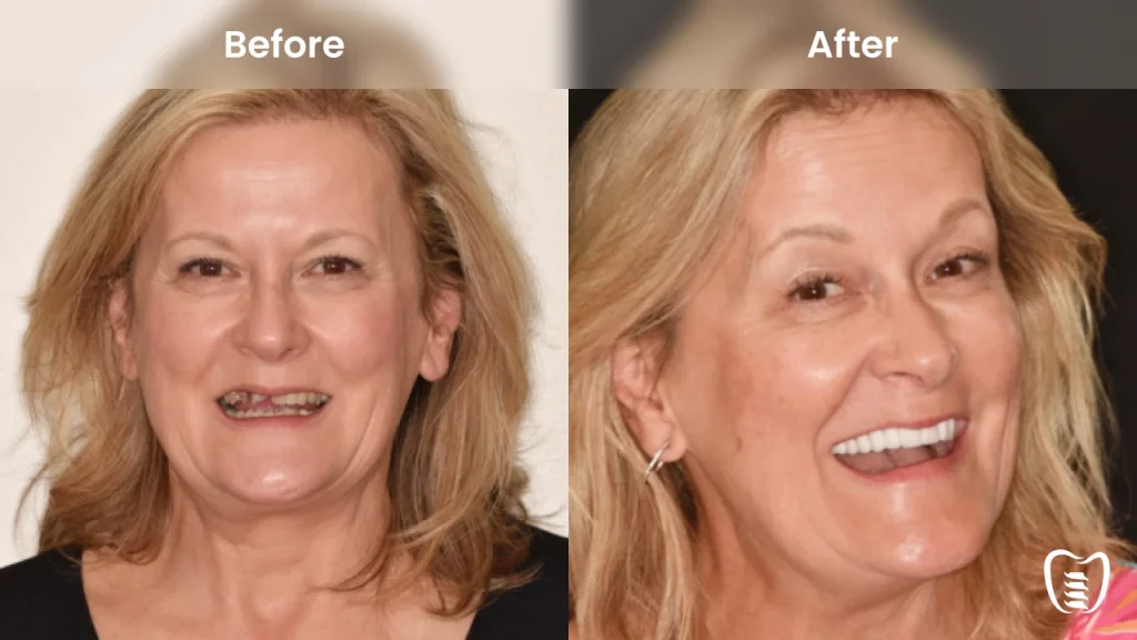 Before and after dental implants at All On Implants Columbia