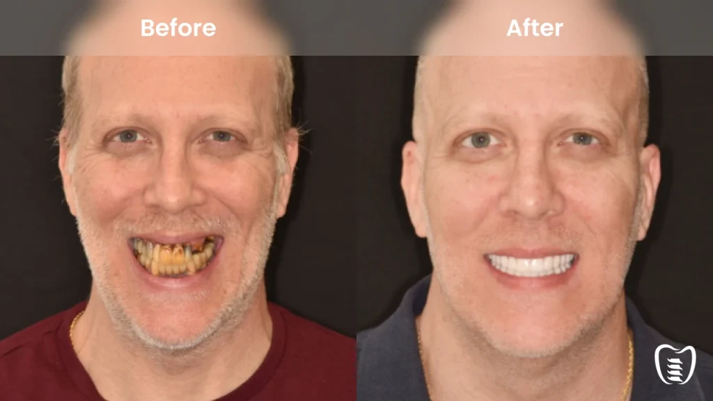 Before and after dental implants at All On Implants Columbia