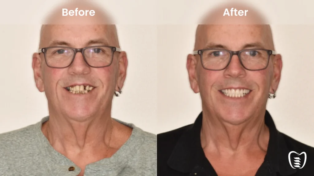 Before and after dental implants at All On Implants Columbia