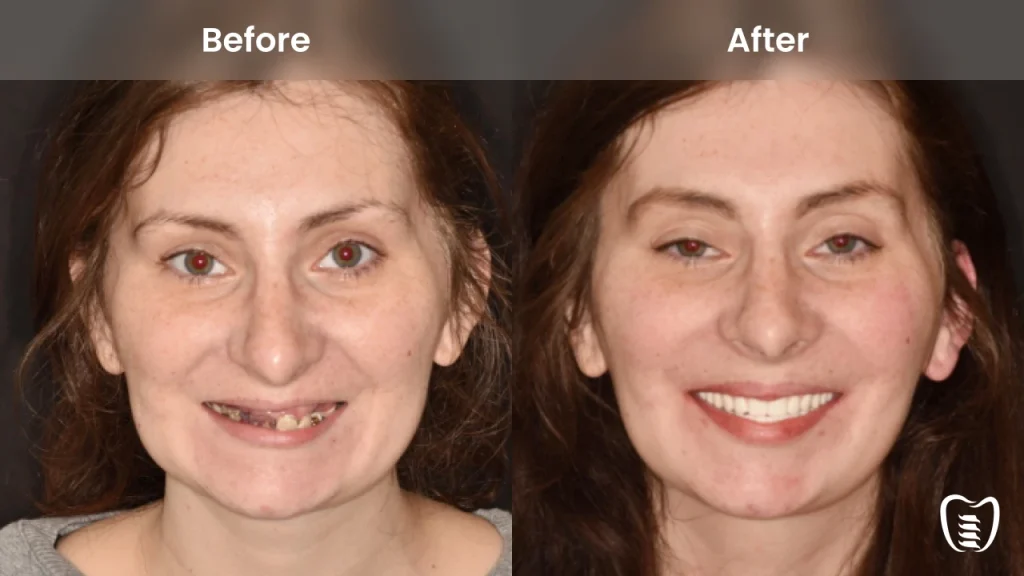 Before and after dental implants at All On Implants Columbia